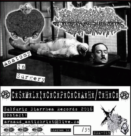 Trabecular Hepatocellular Carcinoma : Anatomy Is Surgery